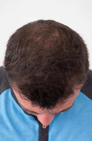 Results Before & After Gallery - Patient 111404 - Image 4