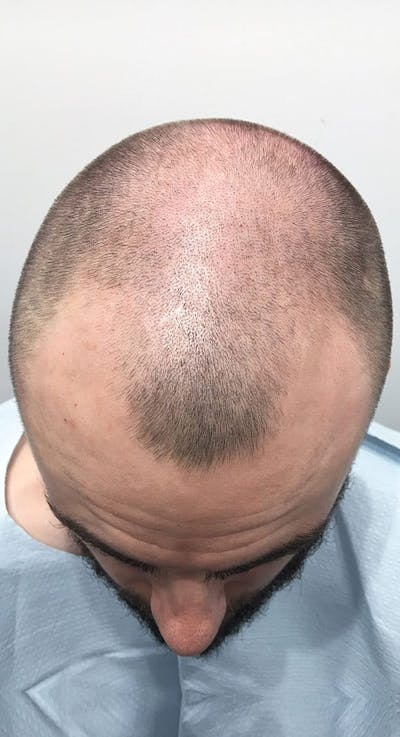 Results Before & After Gallery - Patient 218079 - Image 1