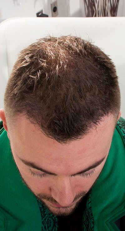 Results Before & After Gallery - Patient 218079 - Image 2