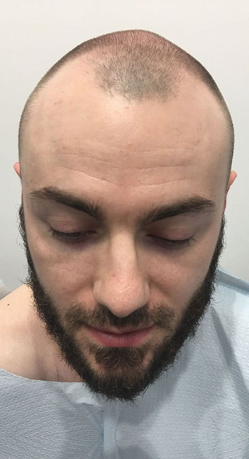 Results Before & After Gallery - Patient 218079 - Image 3