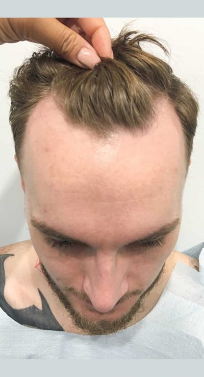 Results Before & After Gallery - Patient 288932 - Image 1