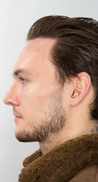 Results Before & After Gallery - Patient 288932 - Image 4