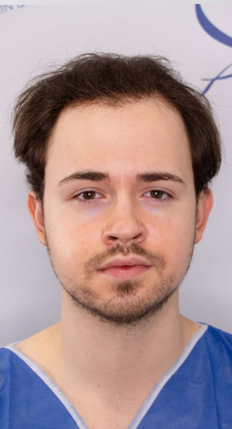 Results Before & After Gallery - Patient 262985 - Image 1