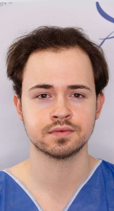 Results Before & After Gallery - Patient 262985 - Image 1