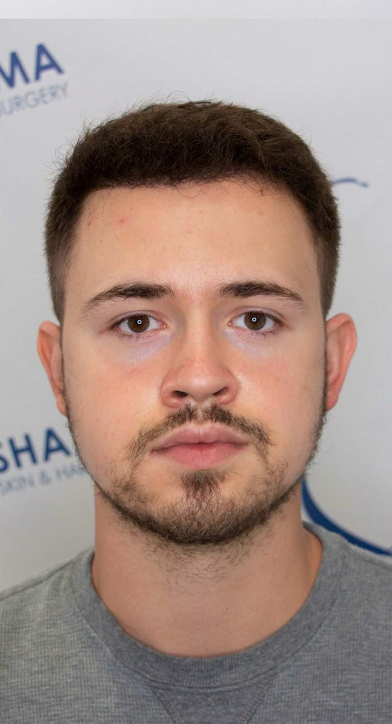Results Before & After Gallery - Patient 262985 - Image 2