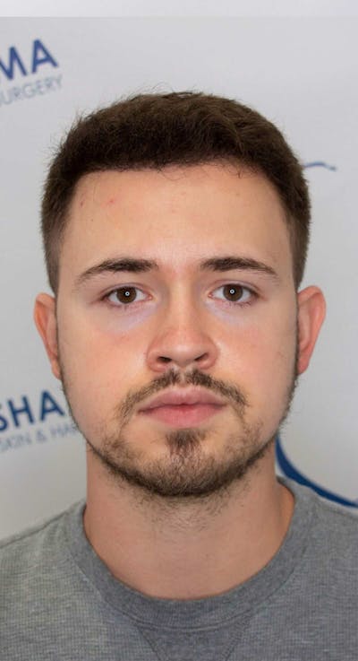 Results Before & After Gallery - Patient 262985 - Image 2