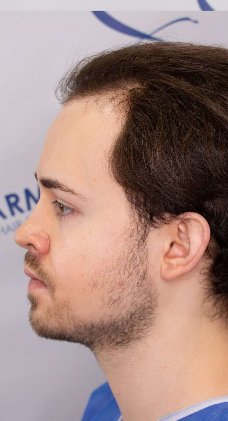 Results Before & After Gallery - Patient 262985 - Image 3