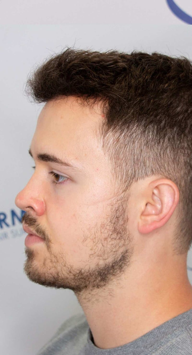 Results Before & After Gallery - Patient 262985 - Image 4
