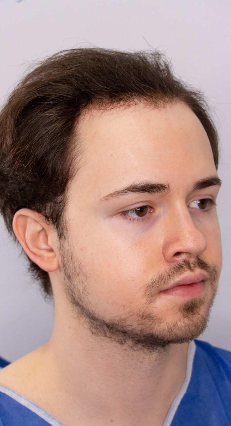Results Before & After Gallery - Patient 262985 - Image 5