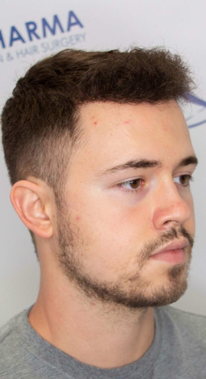 Results Before & After Gallery - Patient 262985 - Image 6