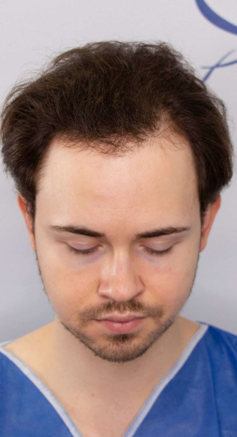 Results Before & After Gallery - Patient 262985 - Image 7