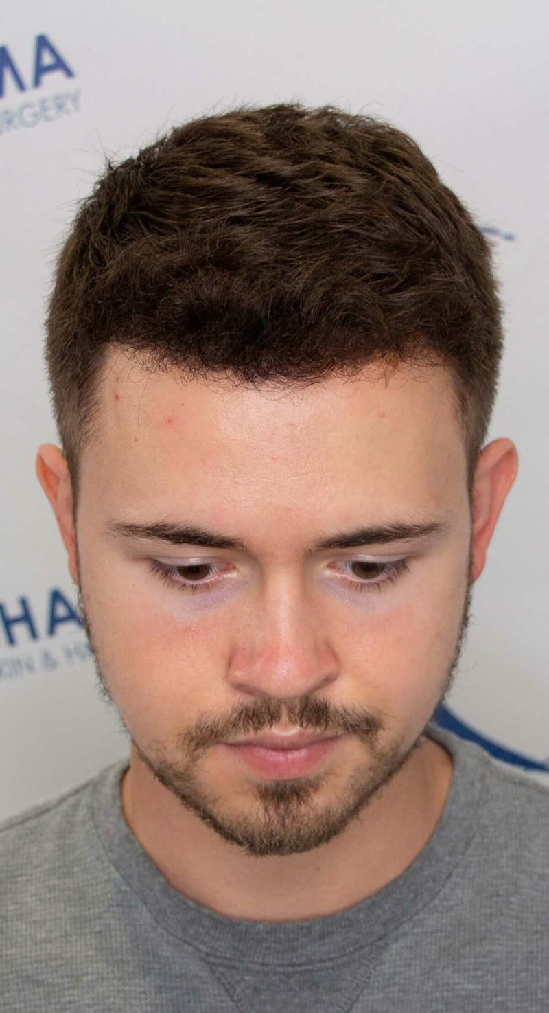 Results Before & After Gallery - Patient 262985 - Image 8