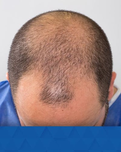 Results Before & After Gallery - Patient 132808 - Image 1