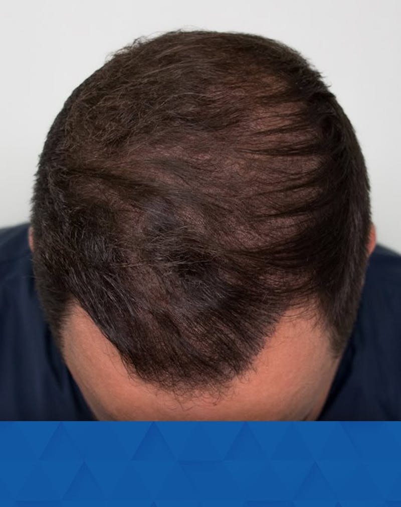 Results Before & After Gallery - Patient 132808 - Image 2