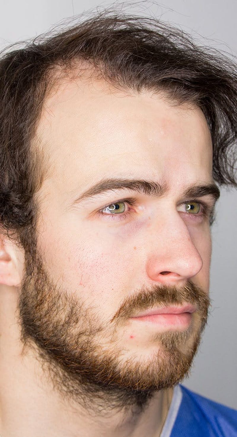 Results Before & After Gallery - Patient 416698 - Image 1