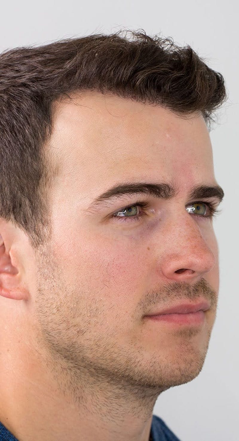 Results Before & After Gallery - Patient 416698 - Image 2