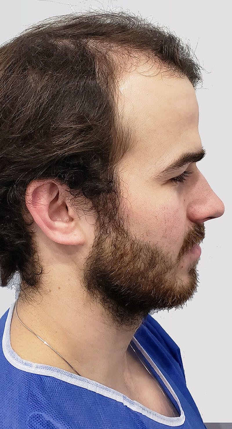 Results Before & After Gallery - Patient 416698 - Image 3