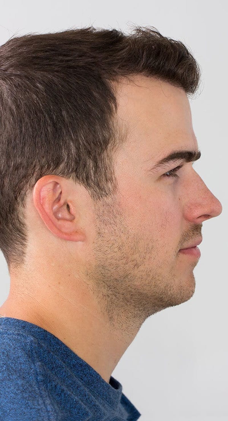 Results Before & After Gallery - Patient 416698 - Image 4