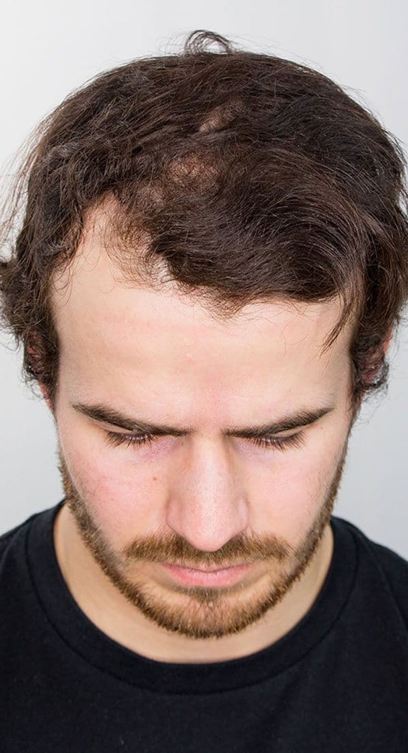 Results Before & After Gallery - Patient 416698 - Image 5