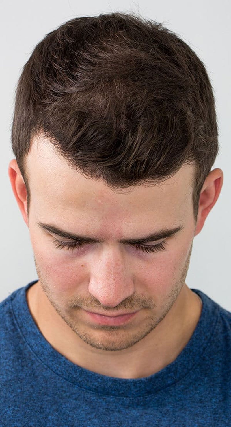 Results Before & After Gallery - Patient 416698 - Image 6