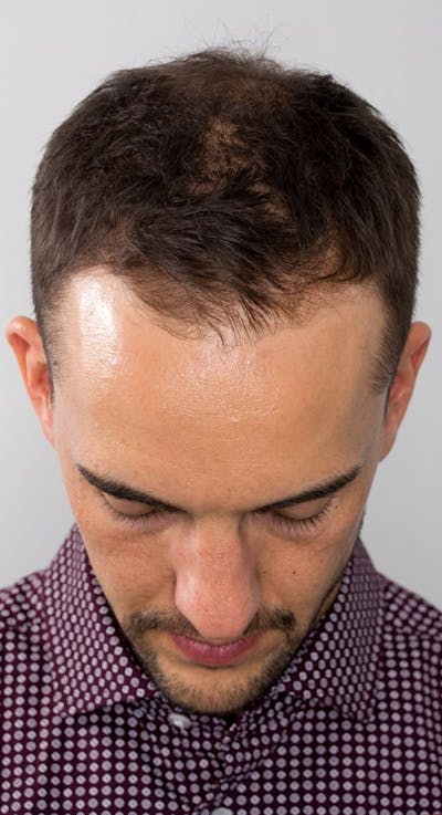 Results Before & After Gallery - Patient 135035 - Image 1