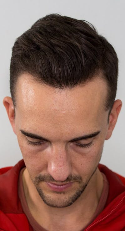 Results Before & After Gallery - Patient 135035 - Image 2