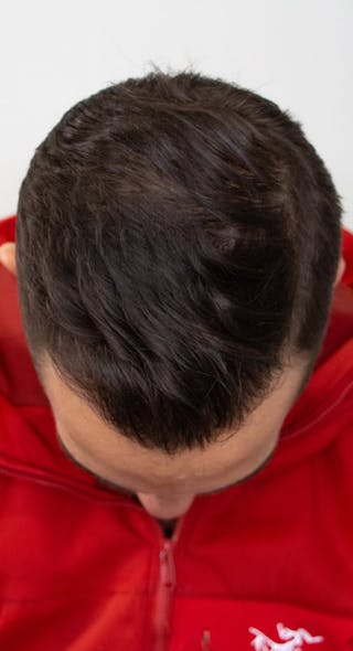 Results Before & After Gallery - Patient 135035 - Image 4