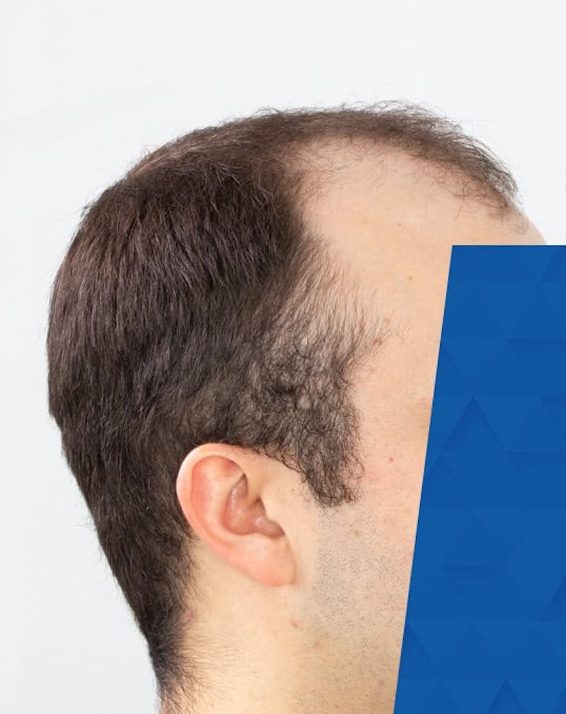 Results Before & After Gallery - Patient 181931 - Image 1