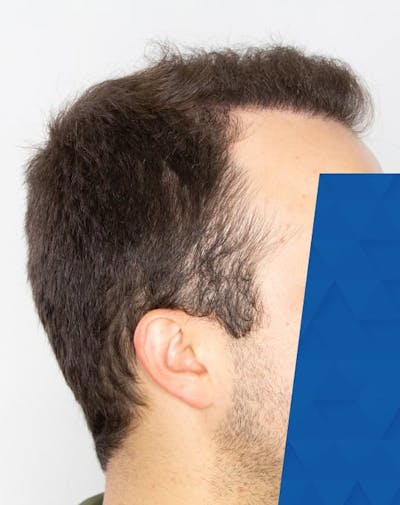 Results Before & After Gallery - Patient 181931 - Image 2