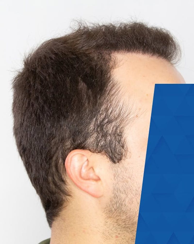 Results Before & After Gallery - Patient 181931 - Image 2
