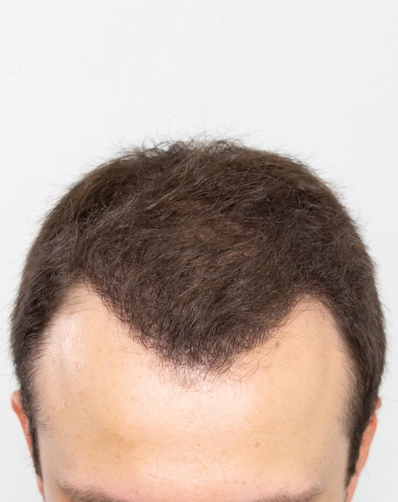 Results Before & After Gallery - Patient 181931 - Image 4
