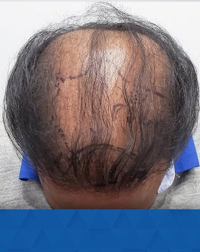 Results Before & After Gallery - Patient 113570 - Image 1