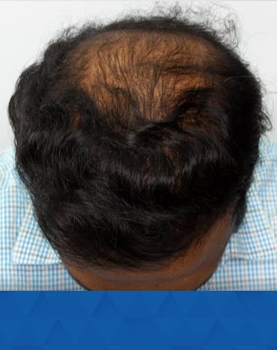 Results Before & After Gallery - Patient 113570 - Image 2