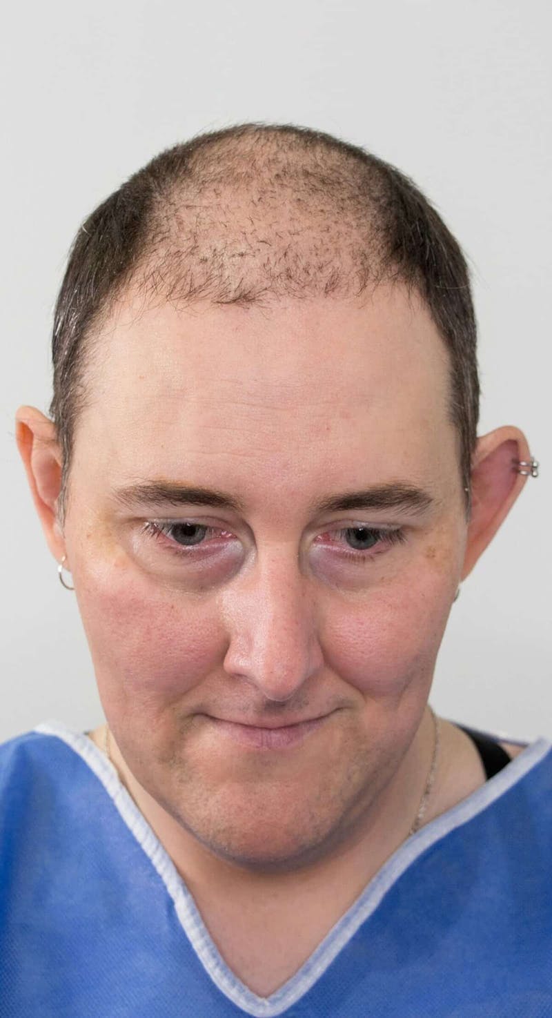 Results Before & After Gallery - Patient 196037 - Image 1