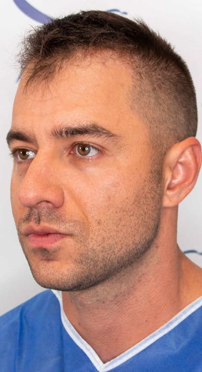 Results Before & After Gallery - Patient 303935 - Image 1