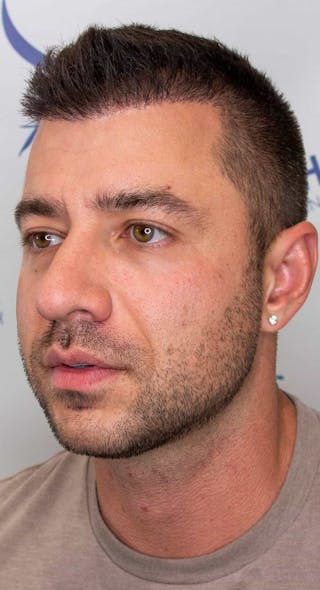 Results Before & After Gallery - Patient 303935 - Image 2