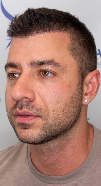 Results Before & After Gallery - Patient 303935 - Image 2