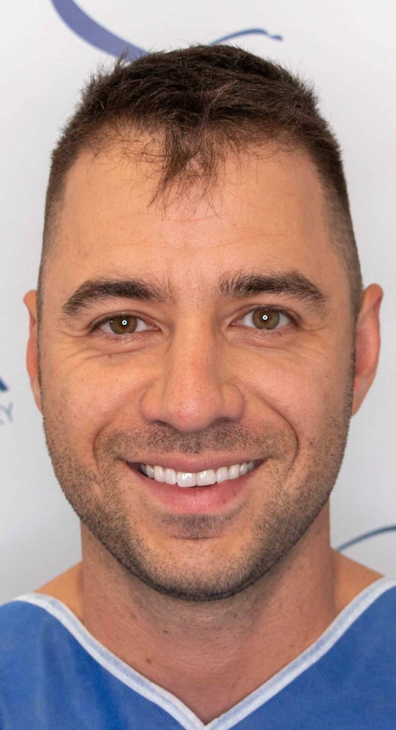 Results Before & After Gallery - Patient 303935 - Image 3