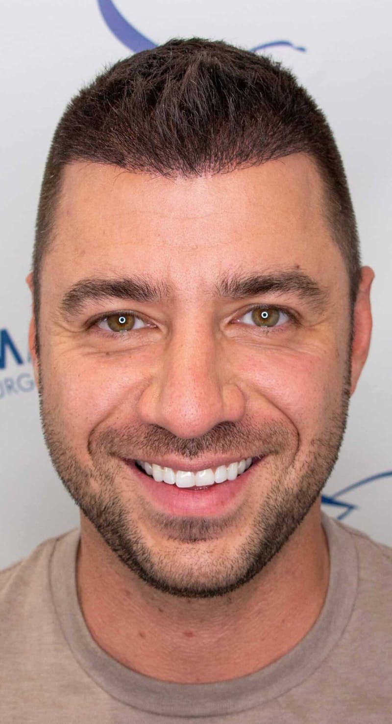 Results Before & After Gallery - Patient 303935 - Image 4
