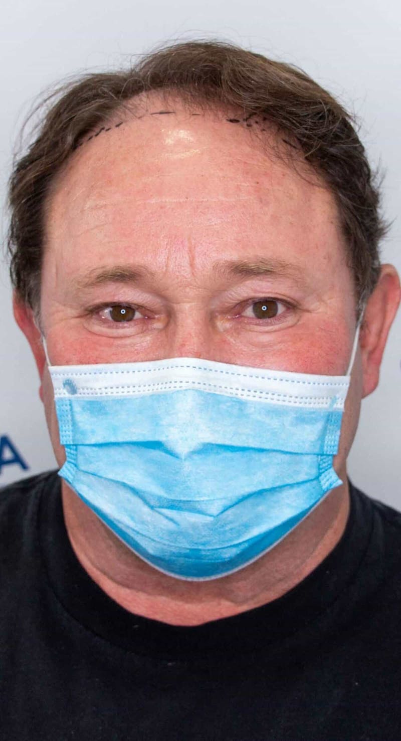 Results Before & After Gallery - Patient 793120 - Image 1