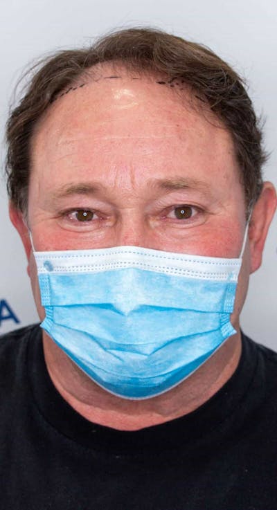 Results Before & After Gallery - Patient 793120 - Image 1