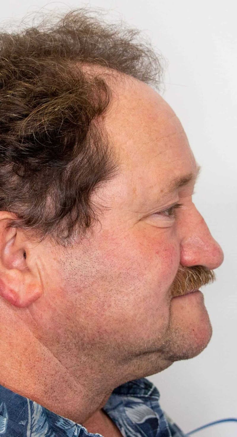Results Before & After Gallery - Patient 793120 - Image 3