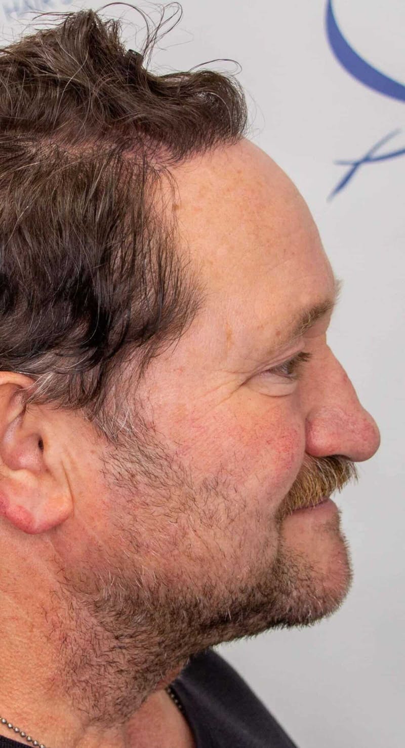 Results Before & After Gallery - Patient 793120 - Image 4