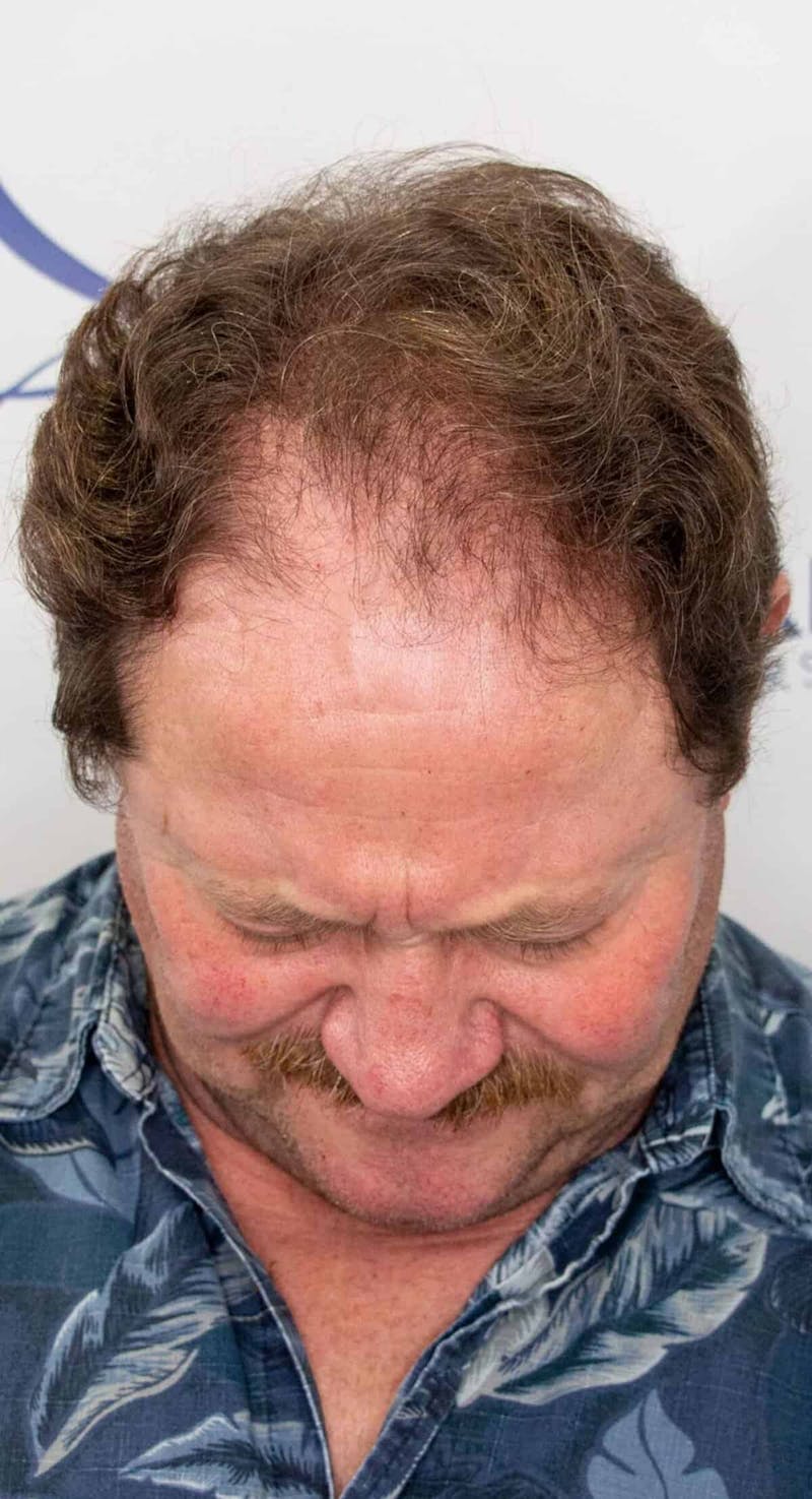 Results Before & After Gallery - Patient 793120 - Image 5