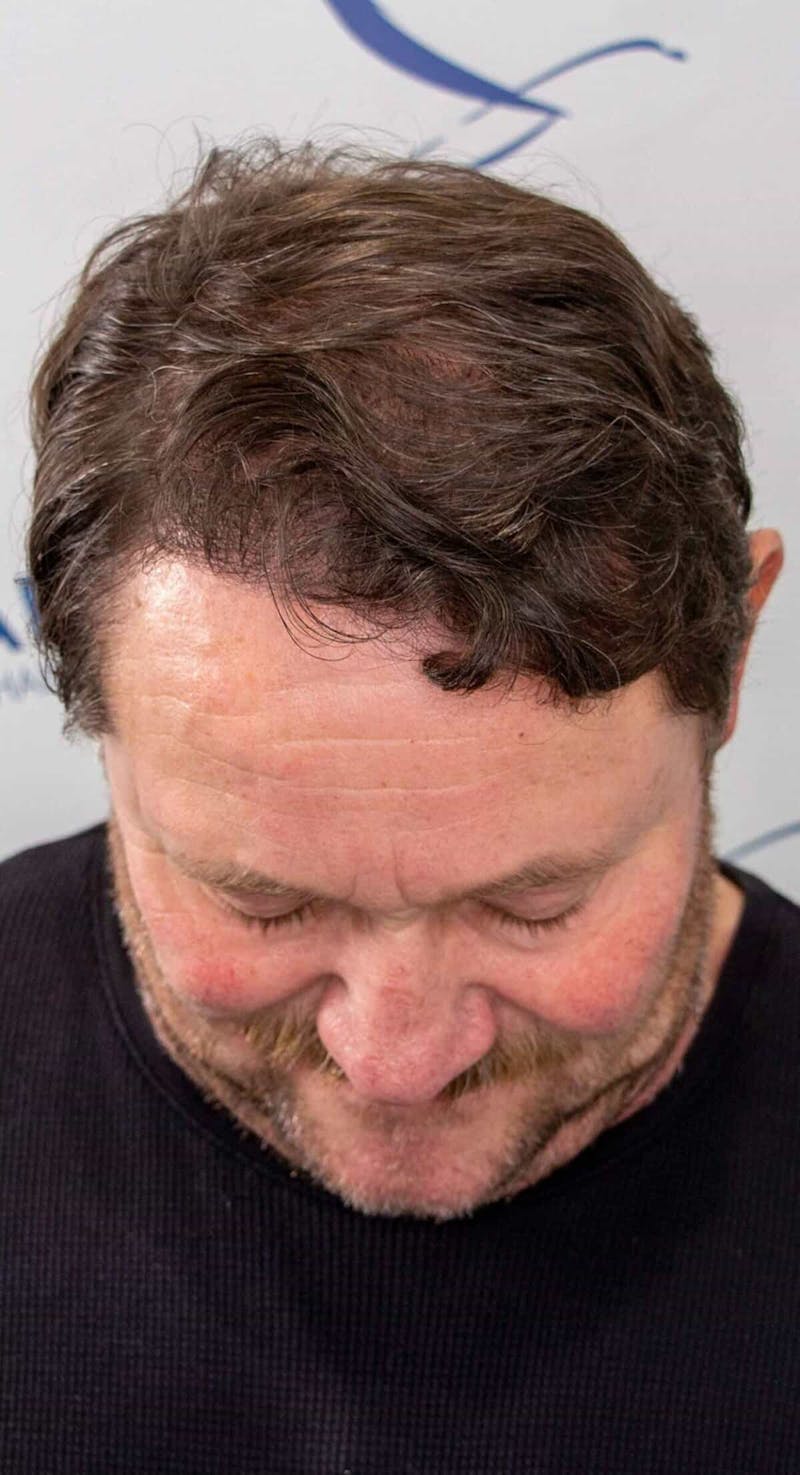 Results Before & After Gallery - Patient 793120 - Image 6