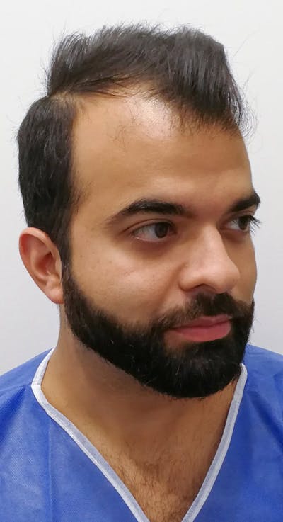 Results Before & After Gallery - Patient 374069 - Image 1