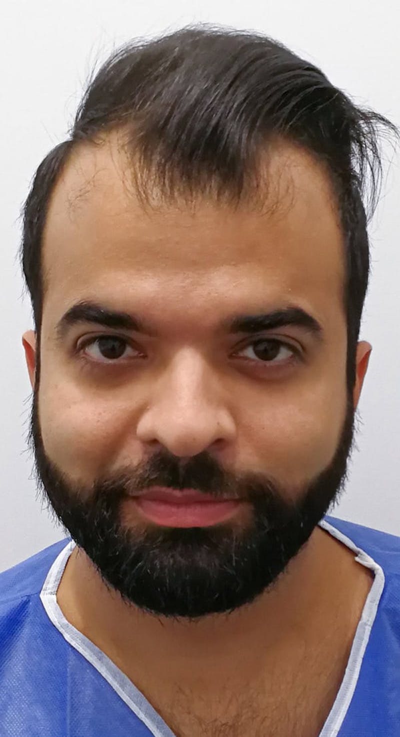 Results Before & After Gallery - Patient 374069 - Image 3