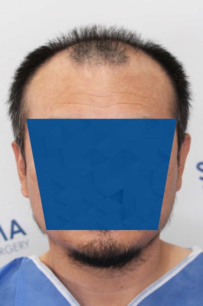 Results Before & After Gallery - Patient 339366 - Image 1