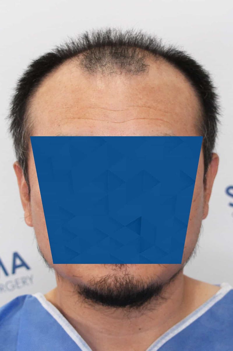 Results Before & After Gallery - Patient 339366 - Image 1