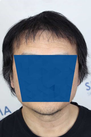 Results Before & After Gallery - Patient 339366 - Image 2